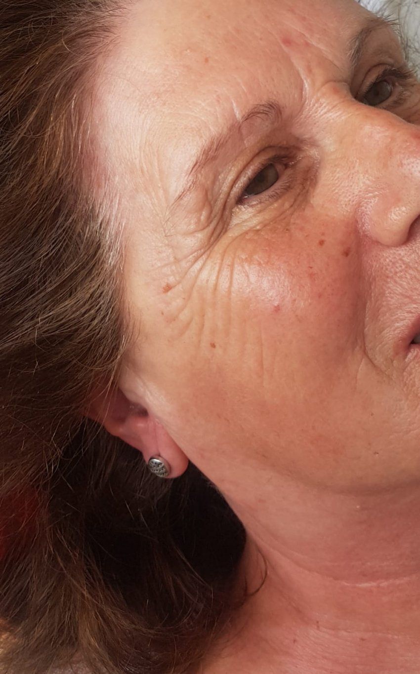 Tratamiento facial de ácido glicólico (ANTES)