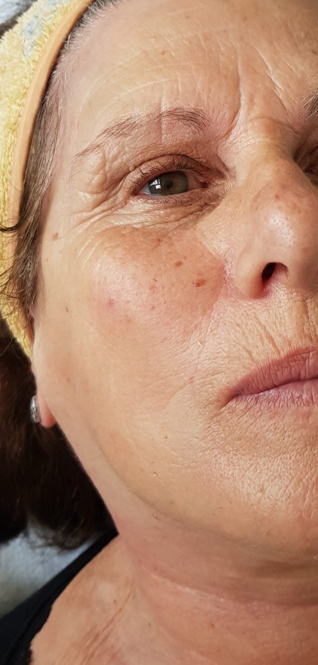 Tratamiento facial de ácido glicólico (DESPUÉS)