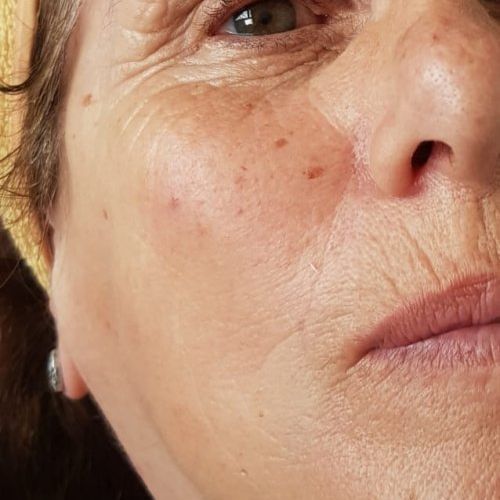 Tratamiento facial de ácido glicólico (DESPUÉS)