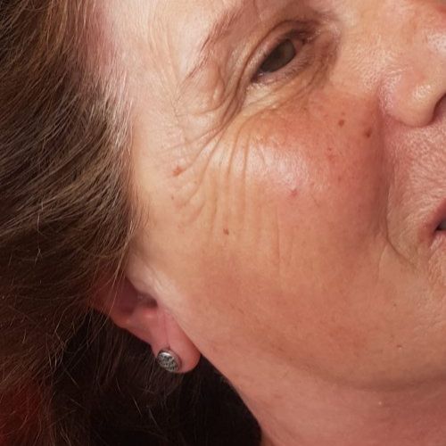 Tratamiento facial de ácido glicólico (ANTES)